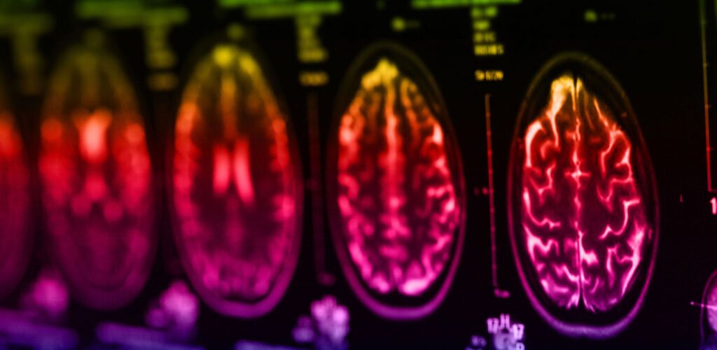 Conquering Alzheimer's Disease 1 Alzheimers
